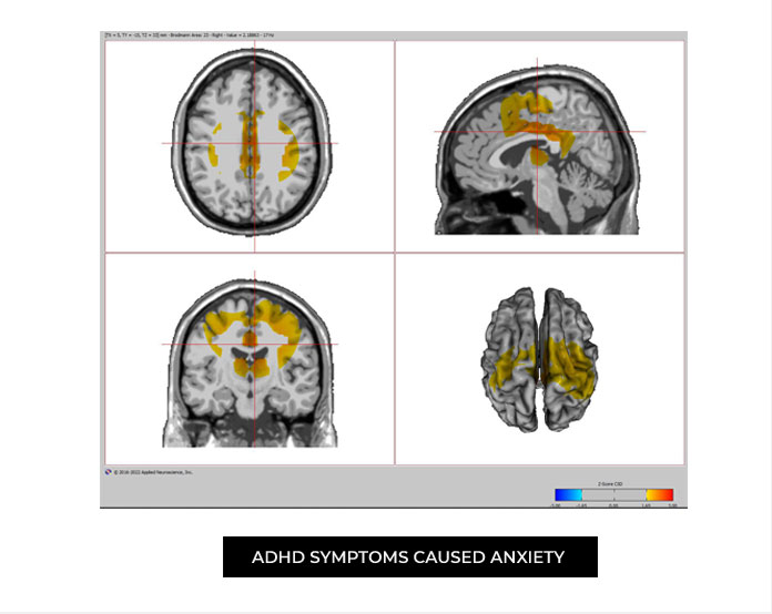 adhd-symptoms-casued-anxiety
